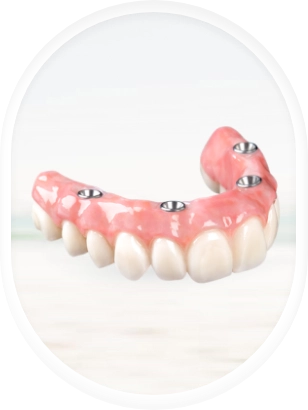 fixed hybrid denture solution, known as All-on-4, showcasing its stability and design.