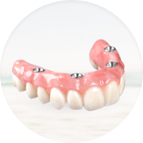 fixed hybrid denture solution, known as All-on-4, showcasing its stability and design.