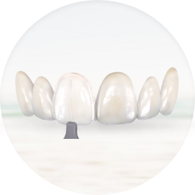 Images showcasing different aspects of veneers treatment