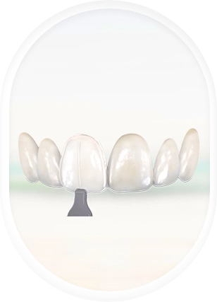 denture composite veneers in puerto vallarta