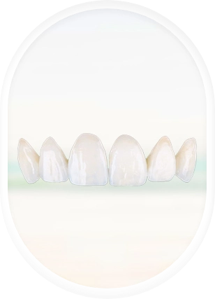denture Porcelain veneers in puerto vallarta
