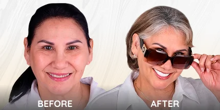 Female dental patient before and after smile transformation showcasing smile and confidence.