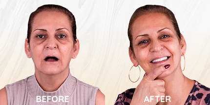 Woman showing before and after cosmetic dentistry results.