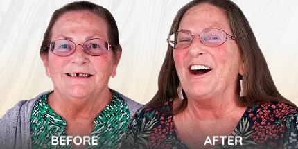 Smiling patient before and after dental treatment comparison.