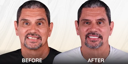 Male patient before and after smile restoration side by side.