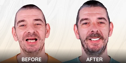 Male patient before and after restorative dental work.