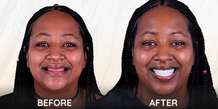 Female patient comparison pictures pre and post smile makeover.