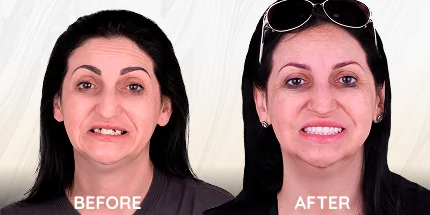 Woman before and after dental transformation results.