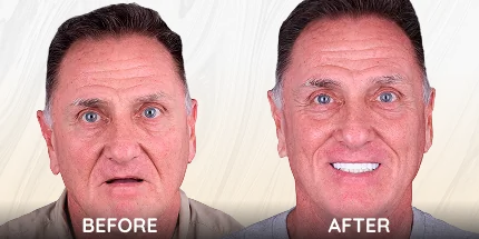 Elder male patient before and after teeth restoration treatment pictures.
