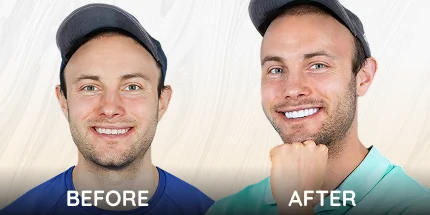Before and after smile transformation with cosmetic dental treatment on male patient.