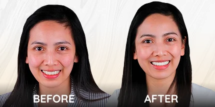 Before and after dental smile makeover results on woman patient.