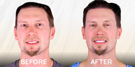 Male patient before and after cosmetic dentistry results at Puerto Vallarta Clinic.