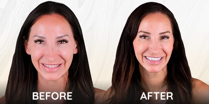 Female patient before and after smile transformation comparison.