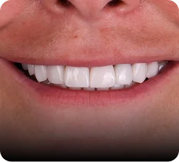 Close-up smile showing composite veneers results.