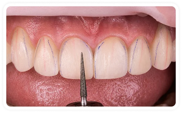 Close-up of composite veneers on upper stained teeth.