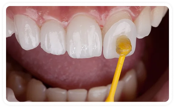 Image showing placement procedure of porcelain veneers on upper teeth.