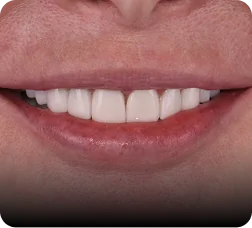  Close-up of smile with porcelain veneers results.