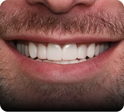 Close-up smile showcasing dental smile design results on male patient.