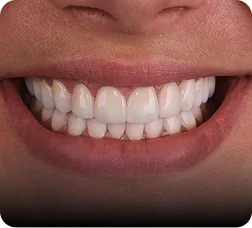 Close-up smile with ultra-thin veneers results.