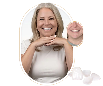 Composite Veneers Cost in Mexico showcasing a patient's enhanced and radiant smile.