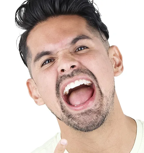 Before and after comparison of veneer treatment in Puerto Vallarta.