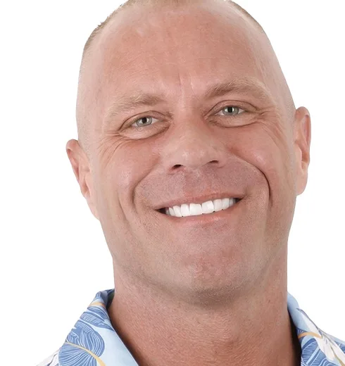 Before and after comparison of veneer treatment in Puerto Vallarta.