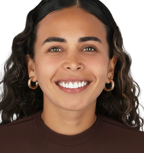 Before and after comparison of veneer treatment in Puerto Vallarta.