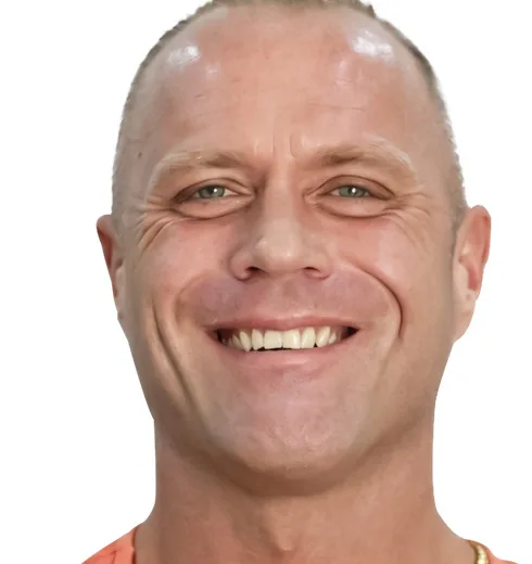 Before and after comparison of veneer treatment in Puerto Vallarta.