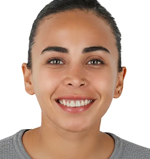 Before and after comparison of veneer treatment in Puerto Vallarta.
